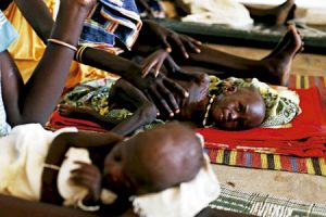 niños desnutridos en Sudán