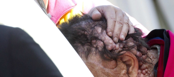 Abrazo papal a un enfermo