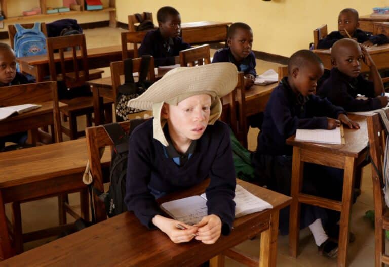 Niño con albinismo en Tanzania